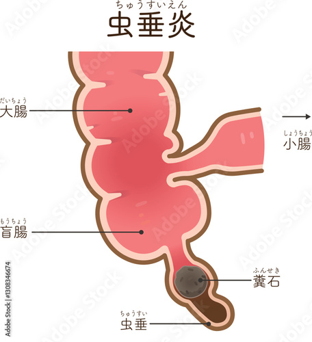 虫垂炎のイラスト appendiciti illustration