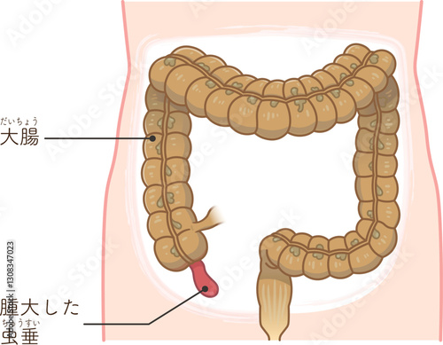 虫垂炎のイラスト appendiciti illustration
