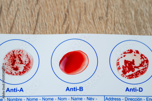 Blood typing test card with Anti-A, Anti-B, Anti-D result, diagnostics and health awareness, personal health and awareness, self-care monitoring, self-testing for diet, agglutination process
