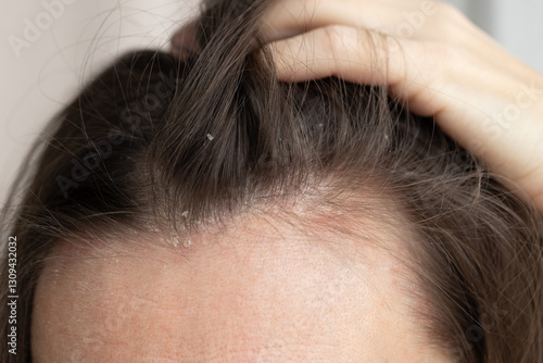 The woman found dandruff on her head. Closeup dandruff flakes on the scalp.