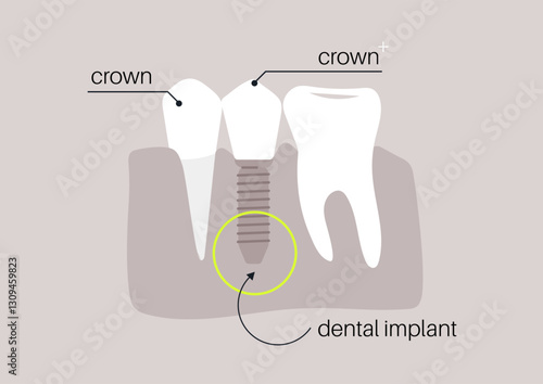 Detailed depiction showcasing the intricate components of a dental implant, highlighting the crown, screw, and adjacent tooth structure for a better understanding of dental restoration processes