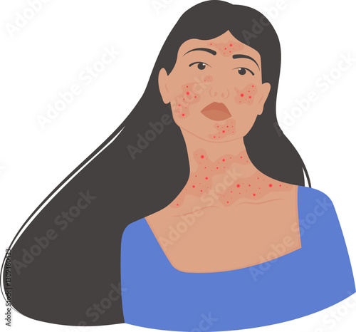 Woman with demodicosis, psoriasis skin disease. Rosacea Awareness Month illustration