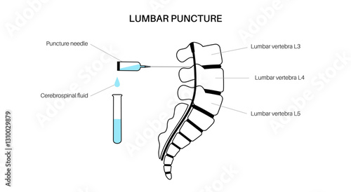 Lumbar puncture spinal tap