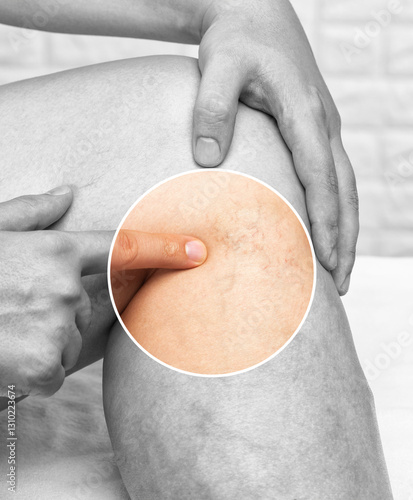 Removal of varicose veins on the legs. Medical inspection and treatment of Telangiectasia. Phlebeurysm.