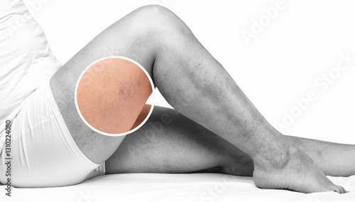 Removal of varicose veins on the legs. Medical inspection and treatment of Telangiectasia. Phlebeurysm.