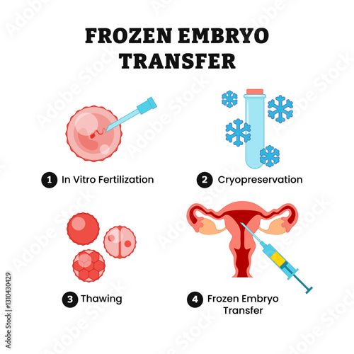 Frozen embryo transfer steps guide, medical illustration vector poster design. Labeled In vitro fertilization (IVF), cryopreservation, thawing egg, fertility treatment, female reproductive system.
