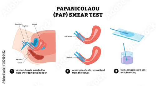 Papanicolau PAP Smear Test process step diagram infographic poster, medical illustration vector. PAP Test labeled speculum inserted, cell is swabbed from cervix, cell sample lab testing.
