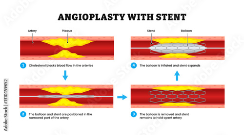 Angioplasty with stent step process diagram infographic, vector illustration. Stent delivery and implantation. Deflated balloon catheter inserted into a coronary artery. Stent expanding a blood vessel