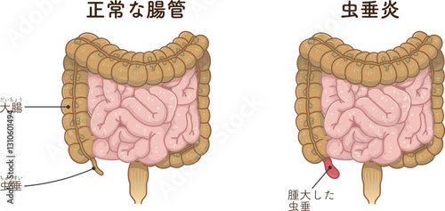 虫垂炎のイラスト appendiciti illustration