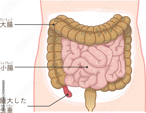 虫垂炎のイラスト appendiciti illustration