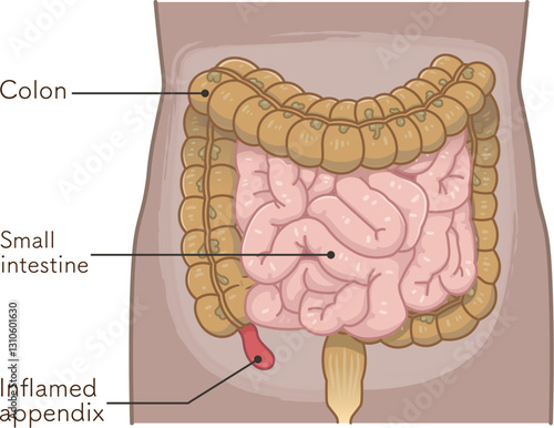 虫垂炎のイラスト appendiciti illustration