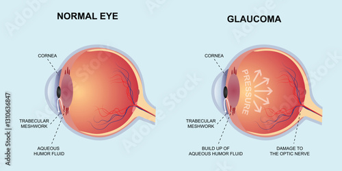 normal eye vs glaucoma vector design