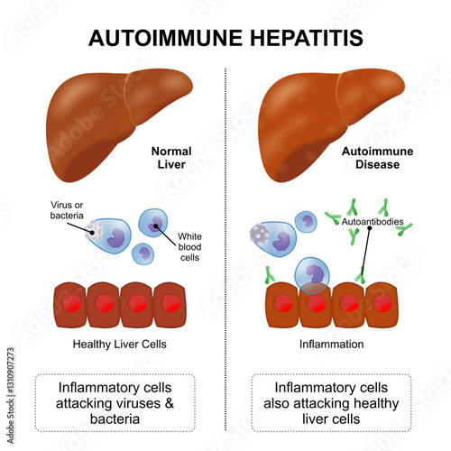 Autoimmune Hepatitis Liver Disease Illustration