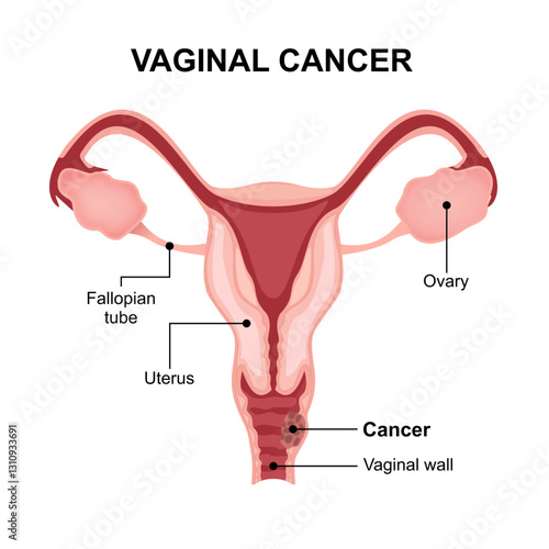 Vaginal Cancer Medical Illustration Female