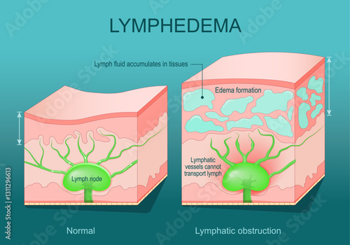 Lymphedema. Cross section of a human skin