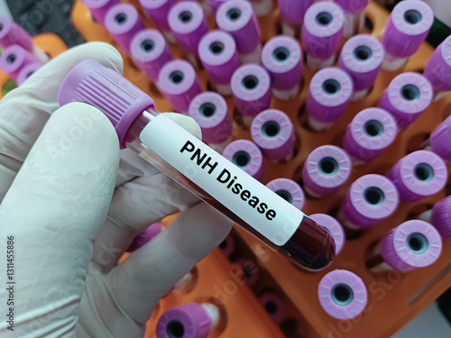 Doctor hold Blood sample for PNH Disease test. Medical testing concept with laboratory background.
