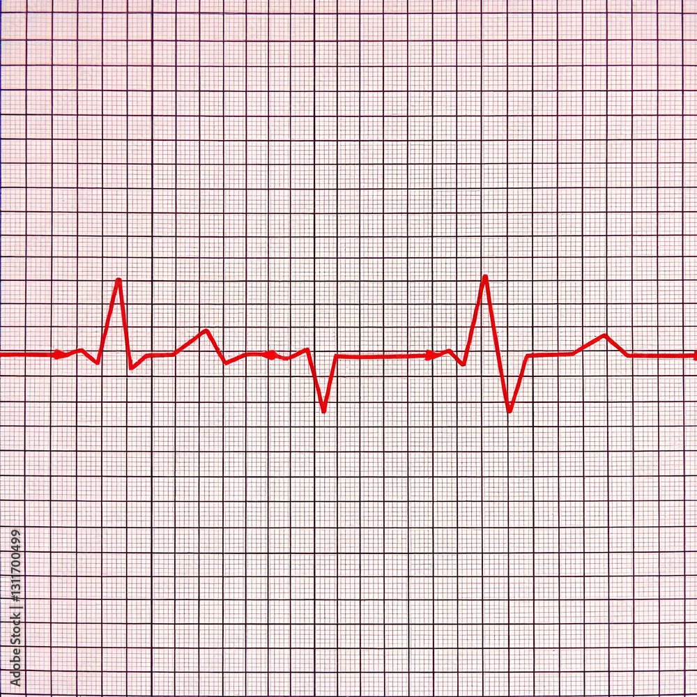 Electrocardiogram short run of ventricular tachycardia (VT). Cardiac fibrillation. Heart beat. ECG. EKG. Vital sign. Life support. Medical healthcare symbol. Electrocardiogram short run of ventricular tachycardia (VT). Cardiac fibrillation. Heart beat. ECG. EKG. Vital sign. Life support. Medical healthcare symbol.
