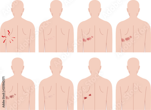 帯状疱疹の症状。背中から見た人間の上半身。 photo