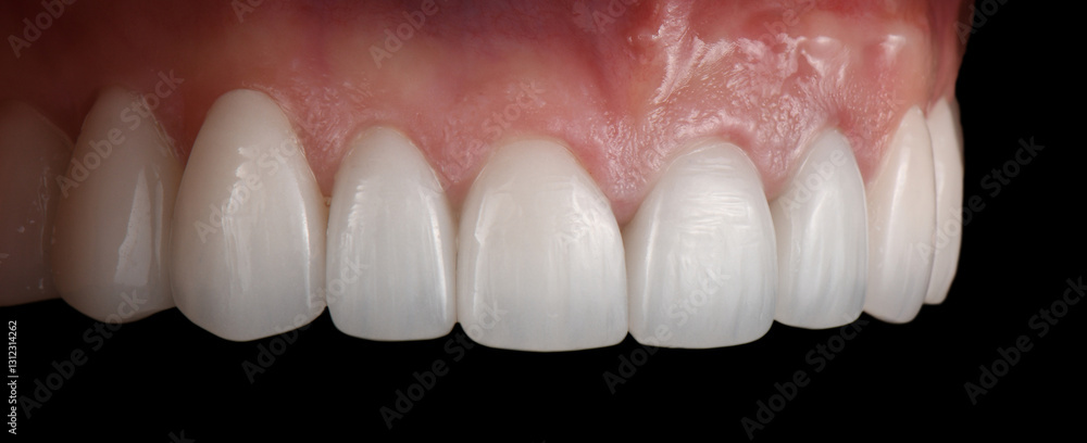 Obraz premium emax ceramic veneers