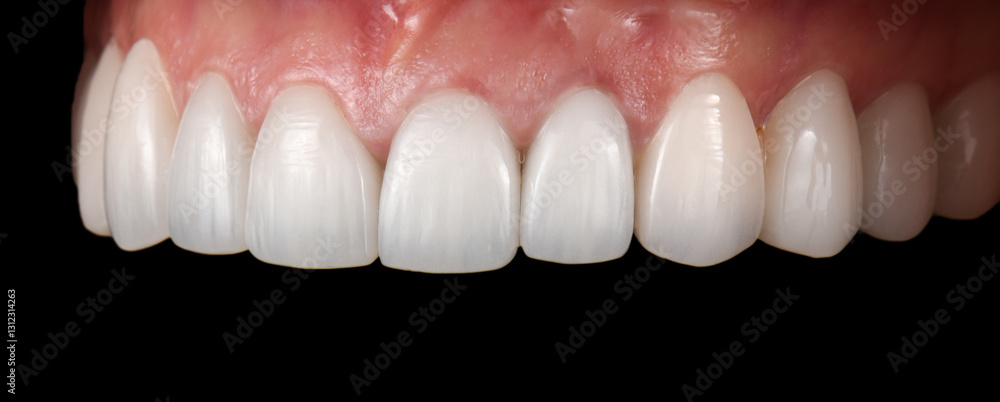 Fototapeta premium emax ceramic veneers