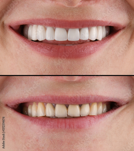 emax ceramic veneers