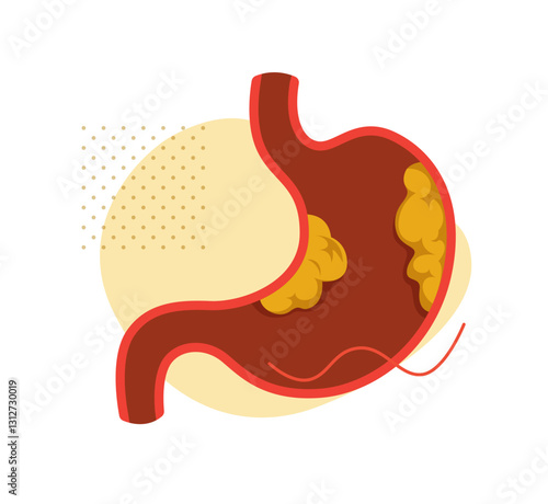 Stomach - Gastric - Cancer - Stock Illustration