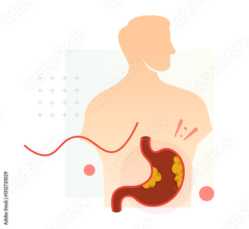 Stomach - Gastric - Cancer - Stock Illustration