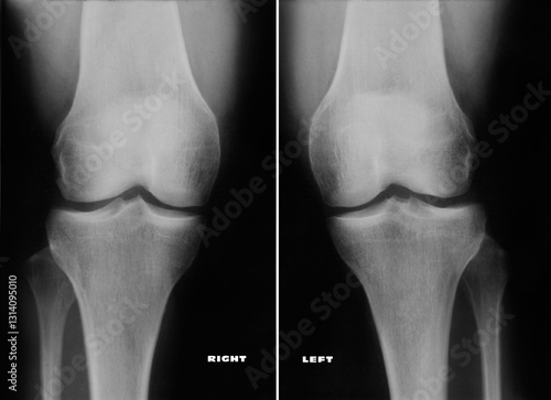 Real X-Ray Left and Right knee Radiograph.  
Radiography film of a 47-year-old woman knees revealing the absence of morphological and structural alterations. Regular width of the various departments.