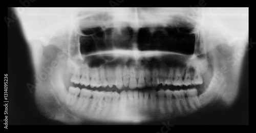 Orthopantomography (OPG) or Radiography of the oral cavity. Real Orthopantomogram or x-Ray film of dental arches of a man with signs of diffuse periodontitis and bone resorption of the root tips. 