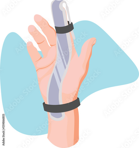 A Zimmer splint for the finger is a medical device used to immobilize and support an injured finger joint by maintaining proper alignment and restricts movement during the healing process.