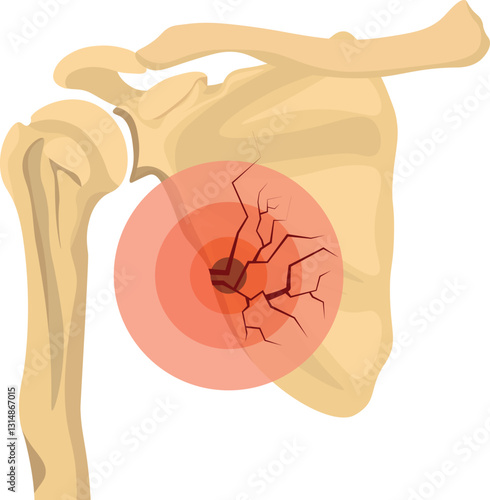 A scapula fracture refers to a break in the scapula, a flat triangular bone located on the posterior side of the ribcage.