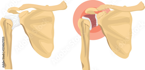 frozen shoulder causing shoulder pain and restrictive movement vector 