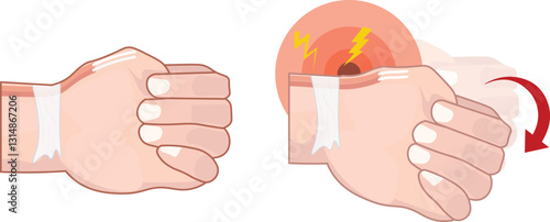 De Quervain Tenosynovitis is an inflammatory condition affecting the tendons on the thumb side of the wrist, specifically the abductor pollicis longus and extensor pollicis brevis tendons. 