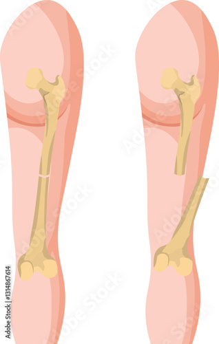 An open fracture is when a broken bone pierces through the skin, exposing the bone and increasing the risk of infection. A closed fracture does not penetrate the skin