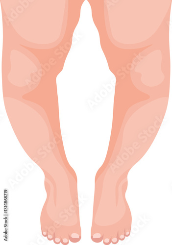 Blount disease is a growth disorder of the tibial bone that causes abnormal inward angulation of the lower leg, primarily affecting children and adolescents