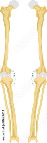 Ricket, Varus deformity, Rickets is a pediatric bone disorder caused by vitamin D, calcium, or phosphate deficiency, leading to weakened and soft bones. 