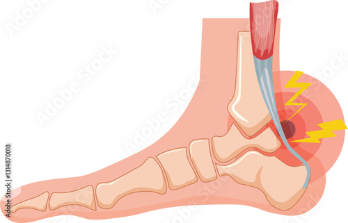 Achilles tendinopathy refers to a chronic overuse injury of the Achilles tendon, typically caused by repetitive stress or strain, often seen in runners, athletes, or individuals with poor biomechanics