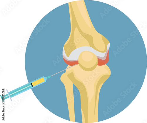 corticosteroids, hyaluronic acid, or platelet-rich plasma (PRP), and are administered directly into the affected join