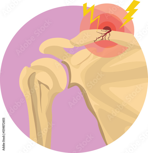 Clavicle fracture