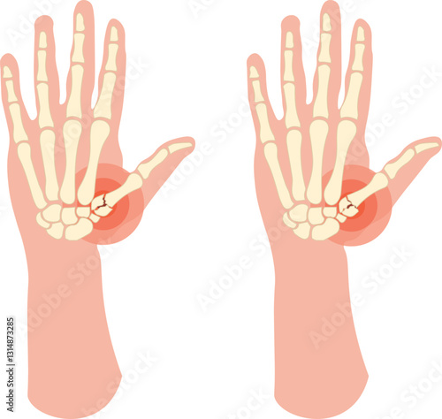 A Rolando fracture is a comminuted, intra-articular fracture at the base of the first metacarpal bone of the thumb, often forming a "T" or "Y" shape on radiographs