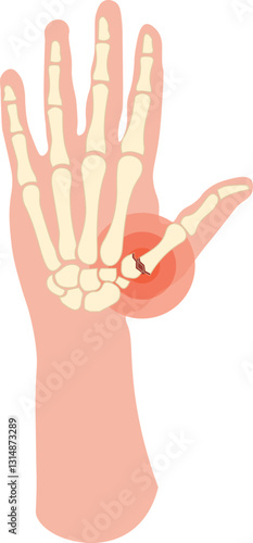 A Bennett fracture is a fracture-dislocation involving the base of the first metacarpal bone at the thumb's carpometacarpal (CMC) joint due to axial force applied to a partially flexed thumb