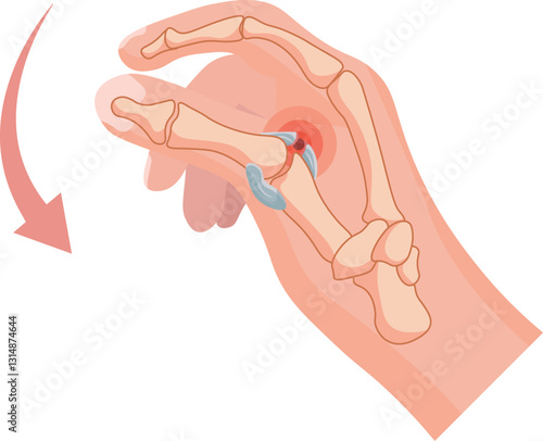 Skier’s thumb is an injury to the ulnar collateral ligament of the thumb’s metacarpophalangeal joint and typically occurs due to a sudden forceful abduction or hyperextension of the thumb
