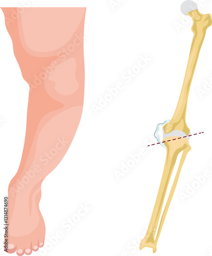 Blount disease is a growth disorder of the tibial bone that causes abnormal inward angulation of the lower leg, primarily affecting children and adolescents