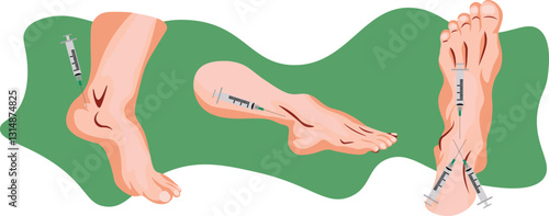 An Ankle Block is a regional anesthesia technique used to numb the foot and ankle for surgical procedures by injecting local anesthetic around the tibial, sural, deep peroneal, and saphenous nerves