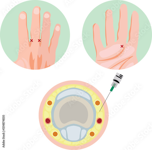 A Finger Block is a regional anesthesia technique used to numb one or more fingers for minor surgical procedures, injury treatment, or pain management