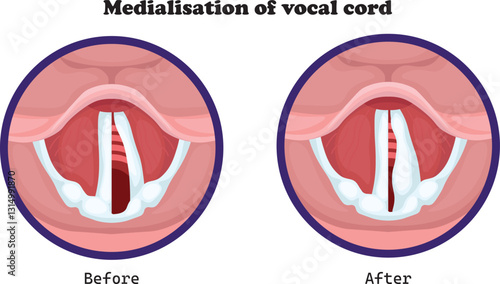 Medialization and lateralization of the vocal cord are surgical procedures used to correct vocal cord paralysis or voice disorders