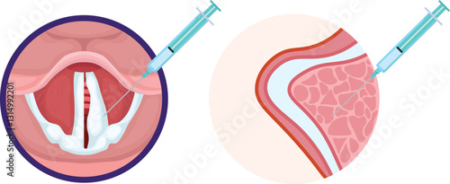 Medialisation of the vocal cord is a surgical procedure used to treat unilateral vocal cord paralysis to reposition the paralyzed vocal cord closer to the midline to improve voice quality