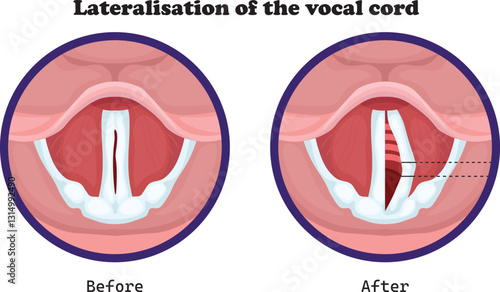 Medialization and lateralization of the vocal cord are surgical procedures used to correct vocal cord paralysis or voice disorders