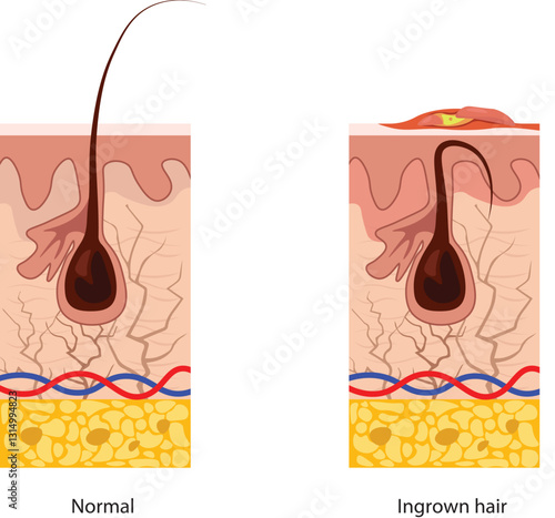 Ingrown hair occurs when a hair curls back or grows sideways into the skin, leading to inflammation, redness, bumps, and sometimes infection.