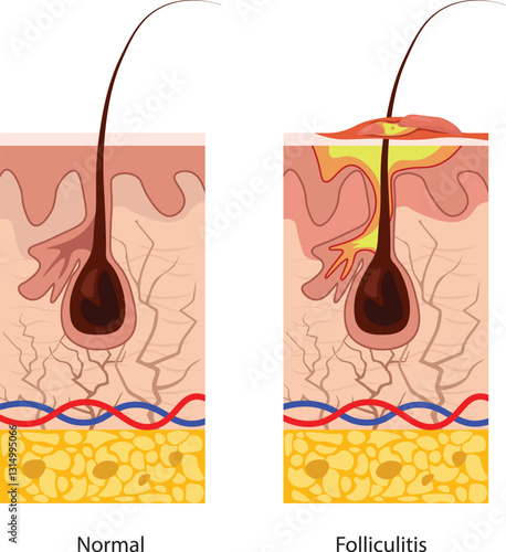 Folliculitis is an inflammation or infection of the hair follicles, often caused by bacteria, fungi, or irritation from shaving or friction causing small red or pus-filled bumps around hair follicles